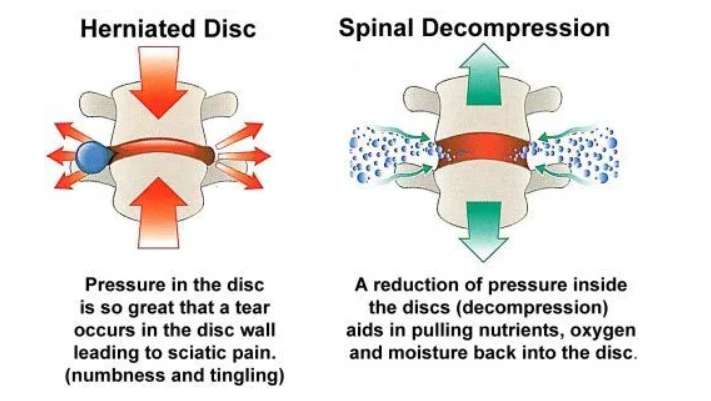 Spinal decompression therapy diagram showing disc pressure reduction — Optimum Chiropractic Care Mobile AL