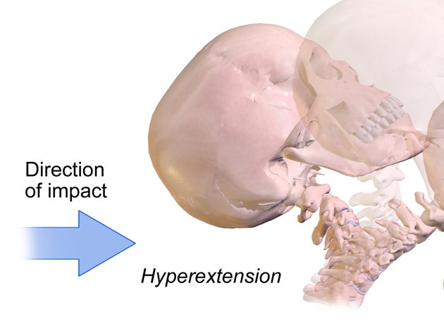 Illustration of hyperextension of the neck during a rear-impact collision