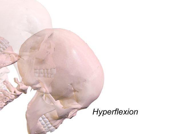 Illustration of the hyperflexion rebound phase of whiplash